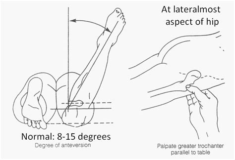 prone tibial torsion test|femoral anteversion and tibial torsion.